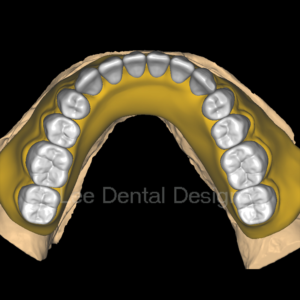 If you lose a tooth, you can make a porcelain tooth or a movable denture. Which one is suitable for you?